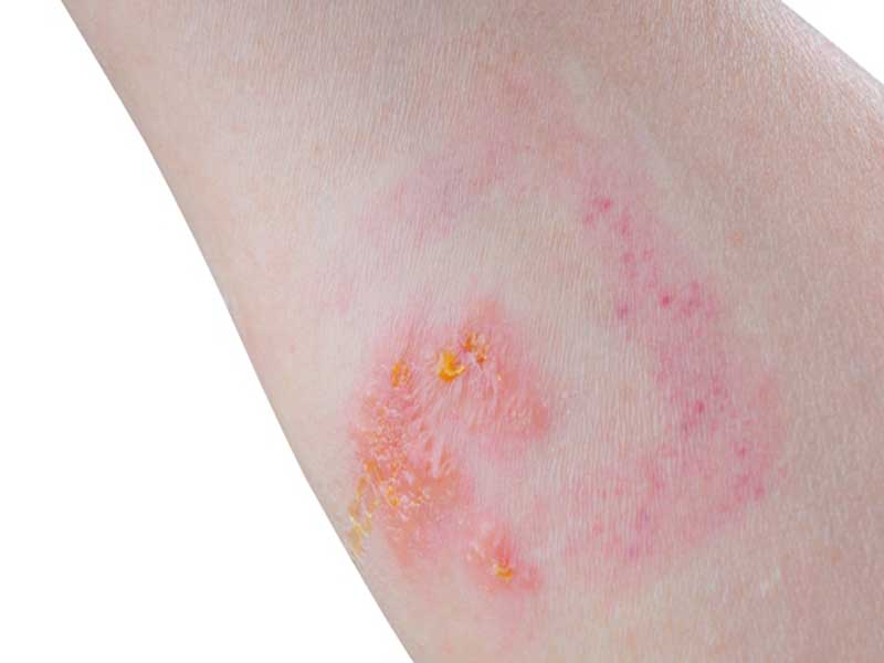 25 Best and Quick Home Remedies For Poison Ivy Rash