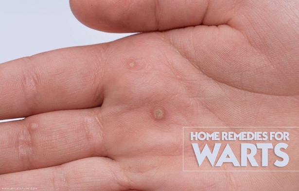 5 Natural and Best Home Remedies For Warts At Home