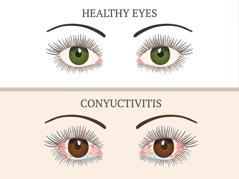 8 Effective Home Remedies to Get Rid of Pink Eye (Conjunctivitis)
